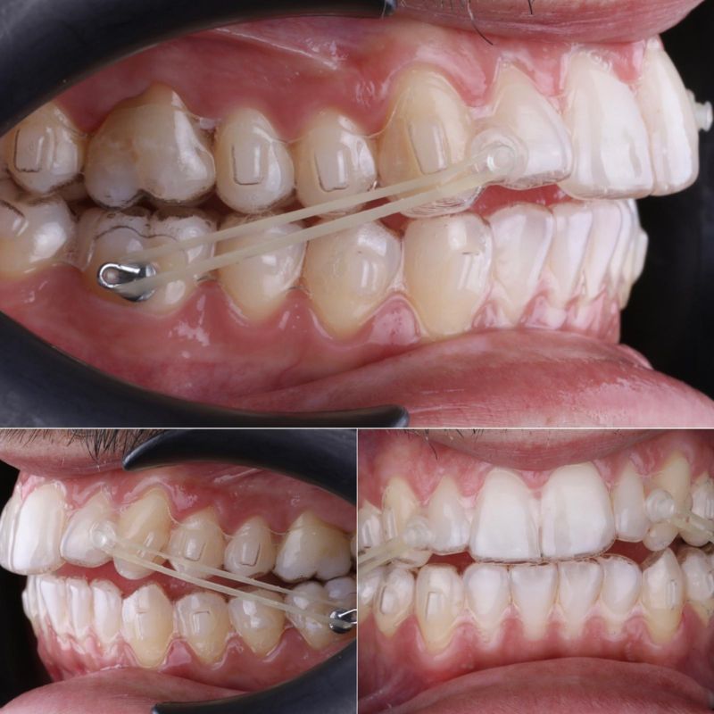Alinhadores invisíveis Angel Aligner em uso, com detalhe dos elásticos e do encaixe sobre os dentes