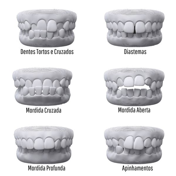 Tipos de mordida: dentes tortos e cruzados, diastemas, mordida cruzada, mordida aberta, mordida profunda e apinhamentos