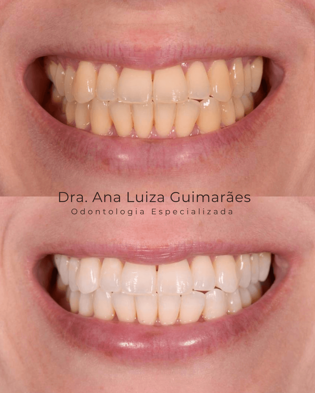 Clareamento Dental