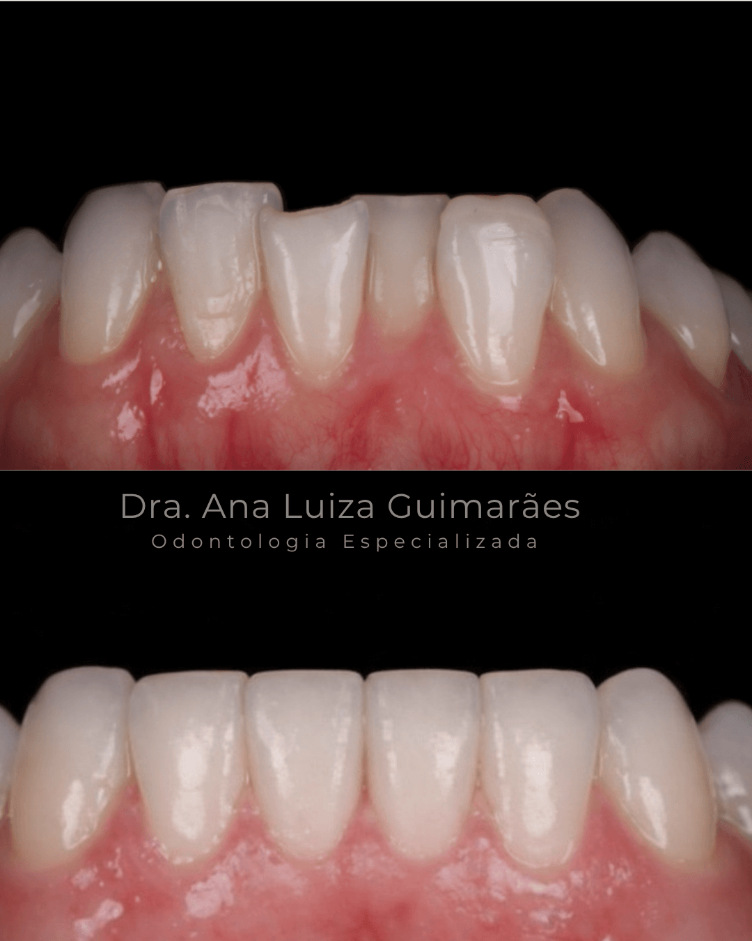 Alinhador Invisível