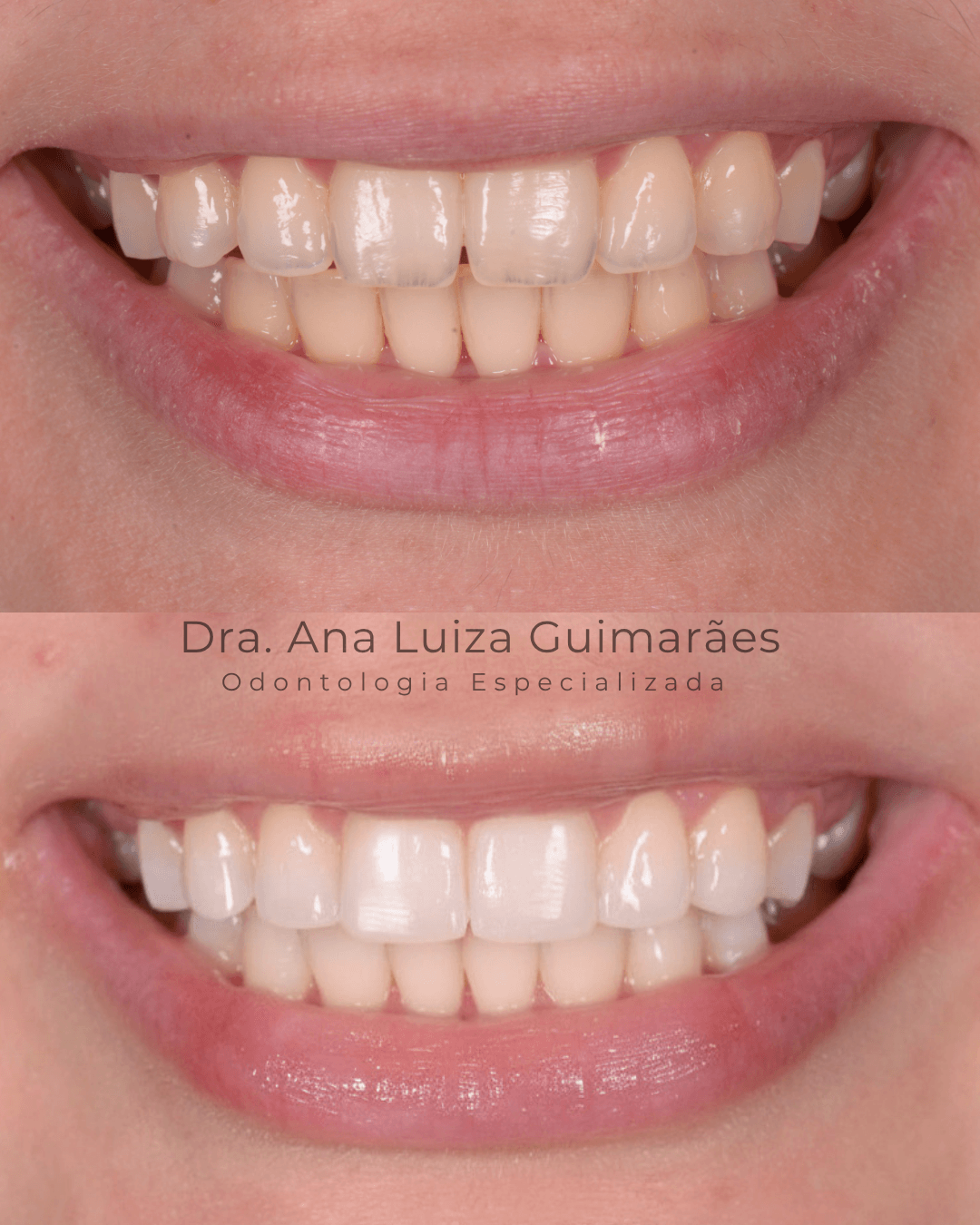 Clareamento + Resina Composta