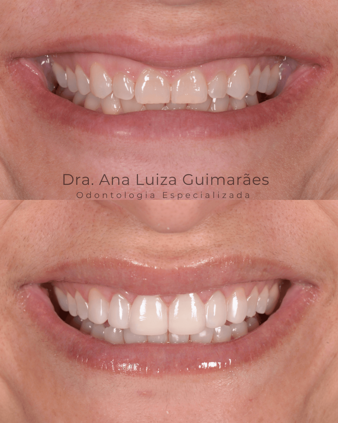 Clareamento + Resina Composta